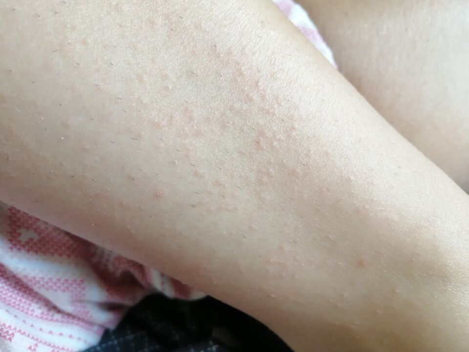 A rash on Elena's legs before using Germivir tablets