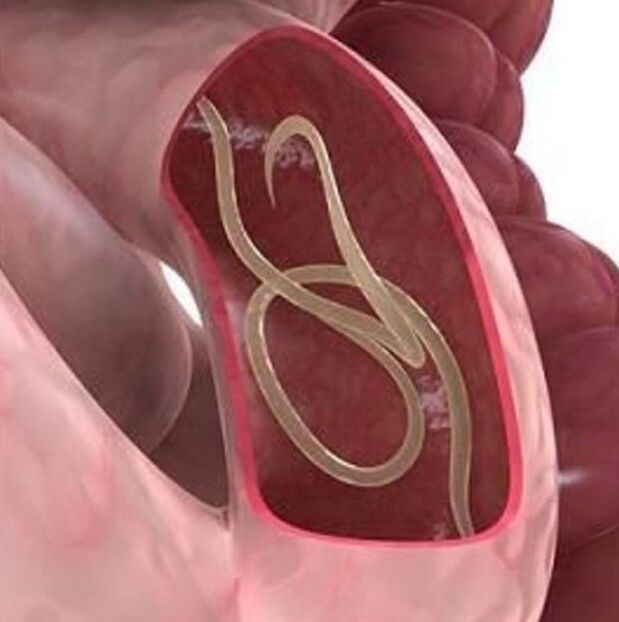 The signs of worms in a person in gastrointestinal tract