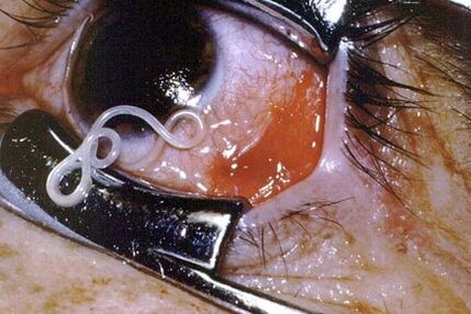 Worms in the eye of the person